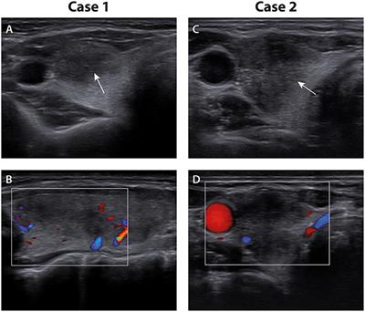 Case Report: Two Cases of Subacute Thyroiditis Following SARS-CoV-2 Vaccination